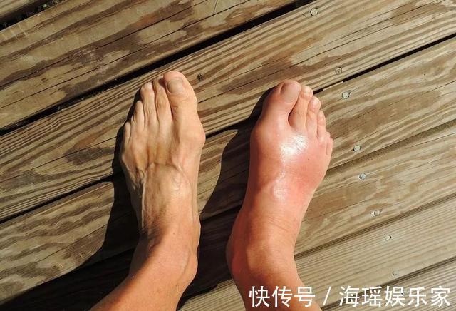 痛风发作|痛风最怕它,煮水喝不痛了!可惜很多人把它当垃圾,太可惜了