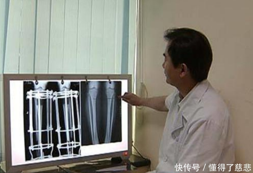 长高|6年前花16万,断骨增高7.2厘米的男生李亚诺,现在代价来了