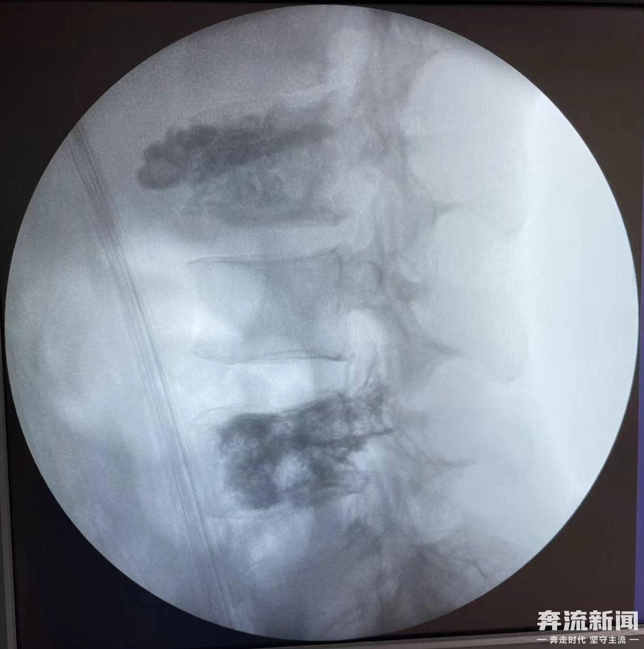 客户端讯|兰大二院成功实施一例肾癌并腰椎骨转移瘤手术