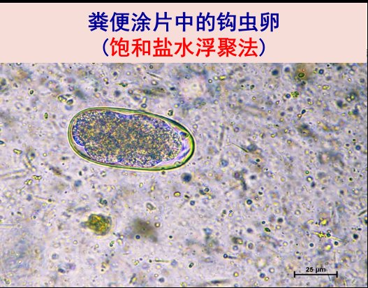 寄生虫|老农赤脚插秧后肚子痛，医生在肠道里发现“葱丝样”的寄生虫