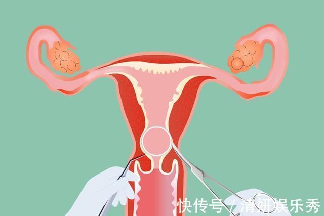 避孕|35岁宝妈“上环”十年整,到医院取下环的一瞬间,医生在心疼她