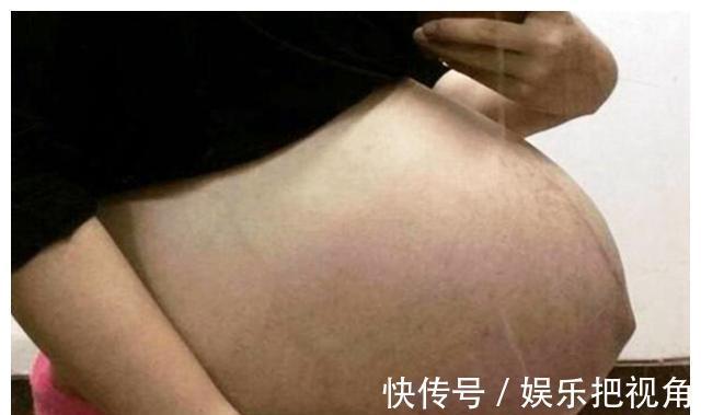 妇产科医生|女人如果多次剖腹产,肚子会变成什么样?看完觉得“头皮发麻”