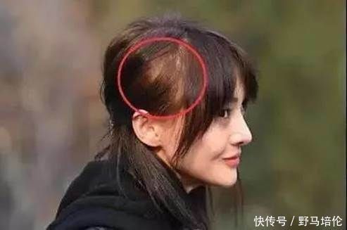 头发|你属于哪种“秃头”类型?找到对应显发量的发型,快来get这些技巧