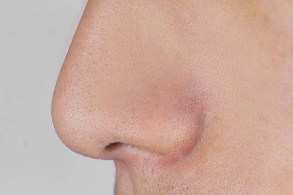 鼻子两侧,挤出的白色分泌物是什么?千万别乱挤,小心越挤越多