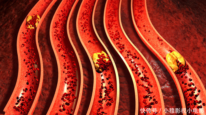 心肌梗死|高血脂都得吃降脂药吗?心血管医生辟谣:并非如此!要具体看!