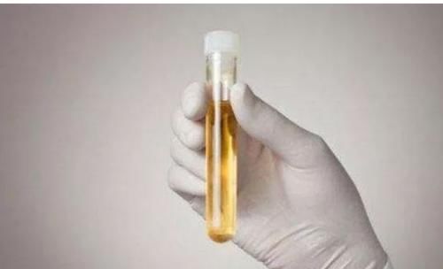 尿路感染|蛋白尿偏高怎么办？医生：牢记“饮食法”，不担心被肾衰竭缠上