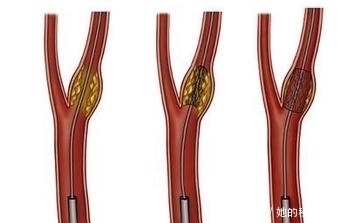 堵塞|颈动脉堵塞随时会引来脑梗,医生说:多吃2种蔬菜,对血管好处多