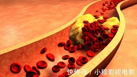 血脂异常|大娘高血脂10年不上升,她是这样做的,坚持2个方法,血脂轻松