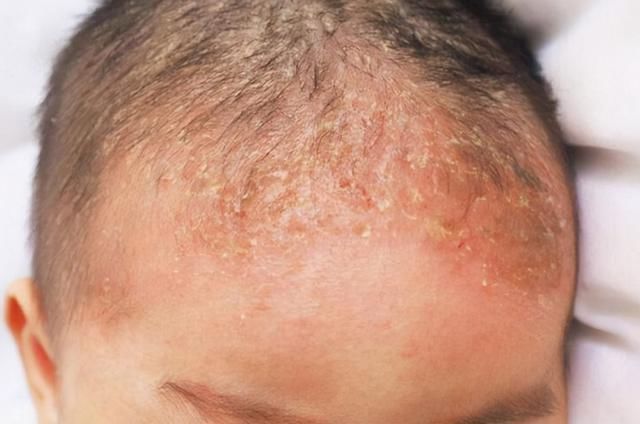 宝宝|发现新生儿小屁屁上有“淤青”，老公想找护士理论，最后暗暗庆幸