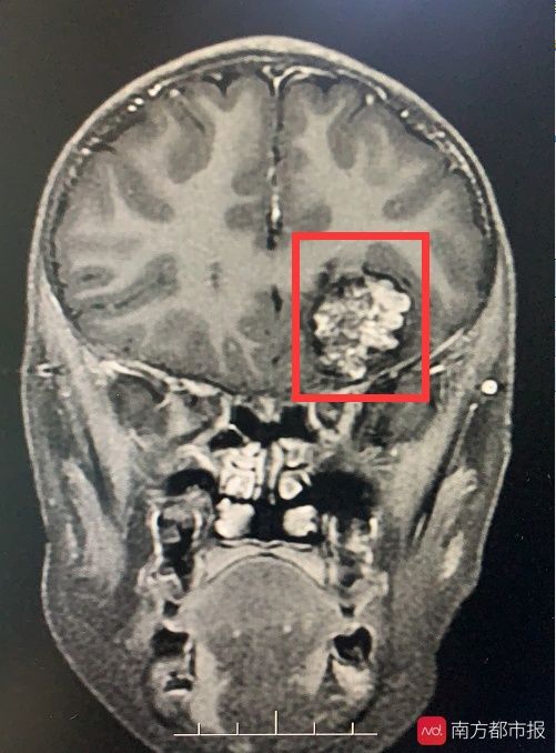 脑肿瘤|6岁儿童一口气读不了“白日依山尽”不是贵人语迟是脑肿瘤