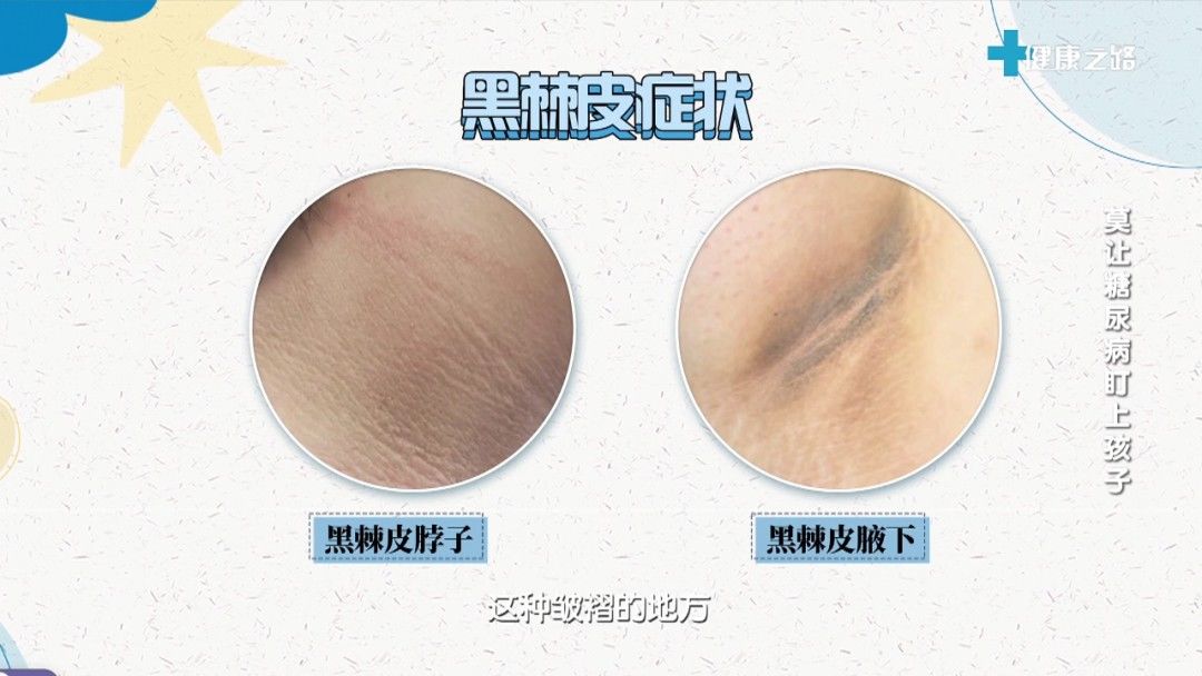 中老年人|这个病不再是中老年人的“专利”,快看看您的孩子有没有这些问题!