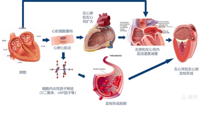 房颤+脑卒中|一站式治疗“房颤+脑卒中”，为患者上“双保险”