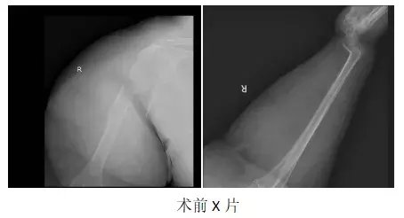 电击伤|完美置换，肩复使命