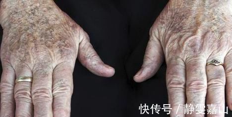 生姜|为什么会出现老年斑？营养师：常用2种食物，更大程度躲开老年斑