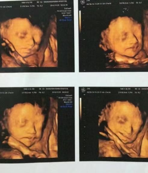 体表|为何有的医院做四维彩超不让家属陪?这3大原因,孕妇有权知道