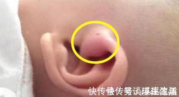 耳朵|儿子的耳朵上有个小洞宝妈试图挤压,导致孩子昏迷,被送到医院