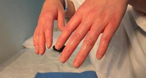 出虛汗|不管男女，愛出汗的人：汗從哪里出，多半“病”也從哪來，別忽視