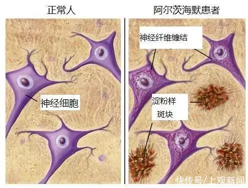 入睡|人到中年睡得少，痴呆早早爬上脑？