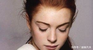 维生素c|脸上有斑太让人烦恼了 别急,教你几种不错的祛斑方法