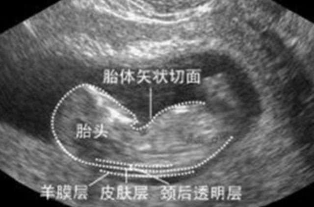 透明层|孕期这项检查,能率先查出畸形儿,产妇却崩溃比高考还难通过