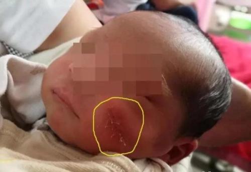 产妇|四年前因吃奶用力过猛,被母亲用剪刀划花脸的男童,如今怎么样了
