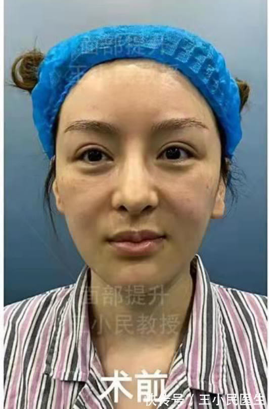 教授 拉皮除皱王小民教授:32岁做小拉皮,变化有多大?