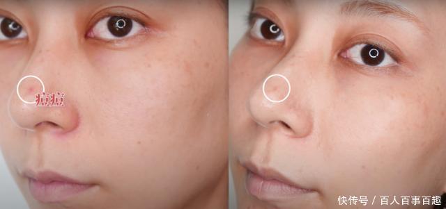 水杨酸|那些脸上没瑕疵的人,都在“酸”些什么