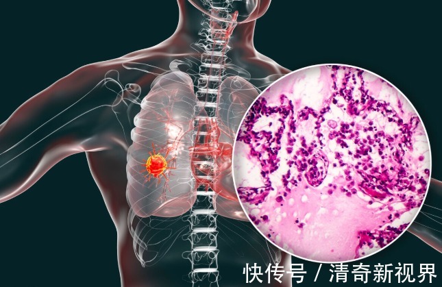 皮肤|肺癌来袭,皮肤先知!医生教你如何通过看皮肤,判断患有肺癌