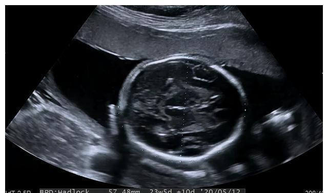 中孕期|中孕期的“大排畸”到底查什么?