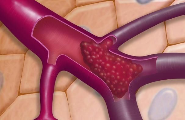 活到|大蒜加它“泡酒”喝,助你活到80无血栓,肾脏宛如30岁,不妨试试