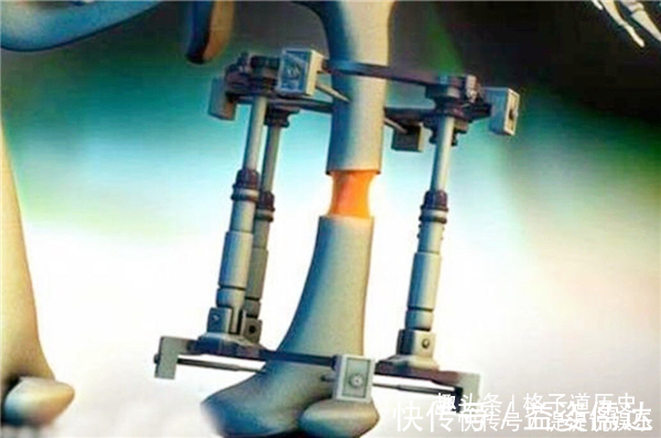 并发症|当年那个花费16万,断骨增高7.2厘米的男生李亚诺,如今怎样了