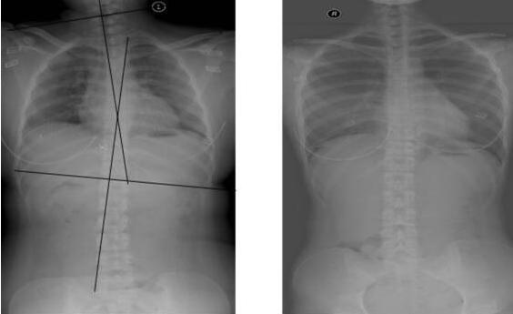 孩子|新生儿被诊断脊柱变形,这几个习惯容易伤害孩子,宝妈尽快改正