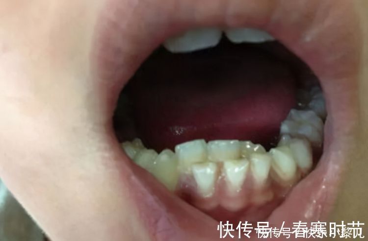孩子|“双层牙”的孩子越来越多,和家长的习惯有关系,很多家庭仍在做