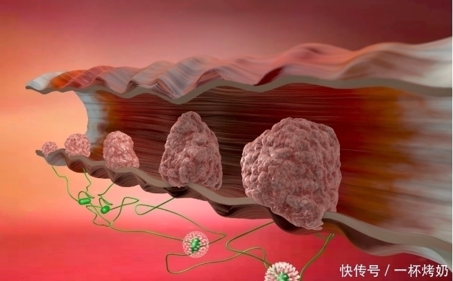 医生|肠癌的症状和前兆,是怎样的?医生的答案来了