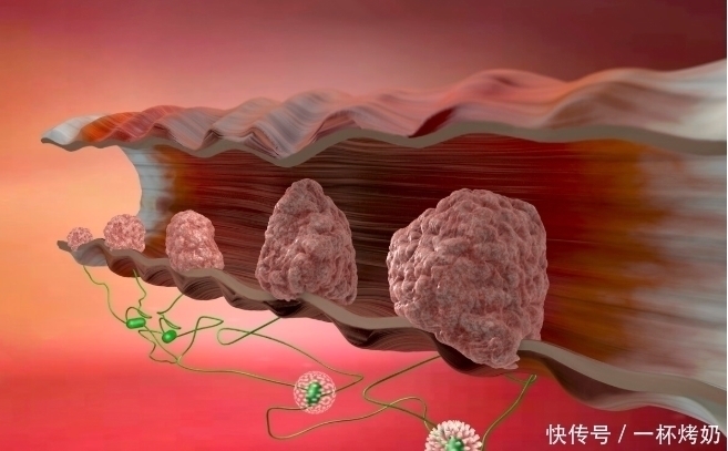 医生|肠癌的症状和前兆，是怎样的？医生的答案来了