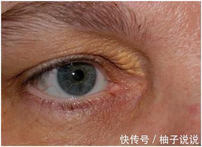 山楂|血管的清洁工不是山楂而是它，若坚持吃，高血脂退避三舍