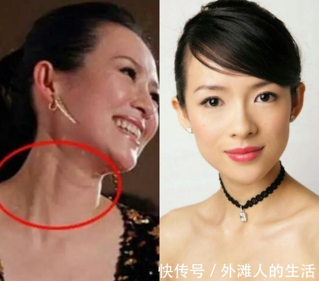 微针 祛颈纹,还是医美最可靠!