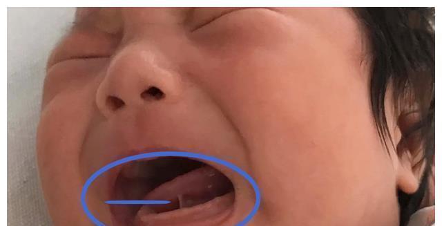 奶奶|宝宝1岁不会说话，奶奶怀疑没给孩子剪舌根，医生：回去吧治不了