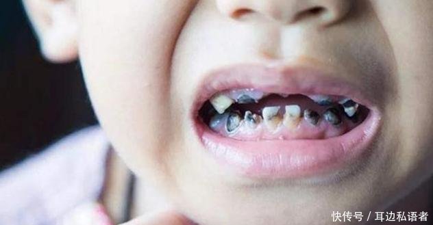 刷牙|3岁儿子满口“小黑牙”,罪魁祸首不是糖果,而是父母的无知