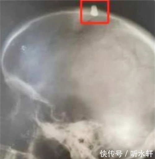 石子|头部被子弹击中,他误认为是石子,跑完52里后,却收获意外惊喜