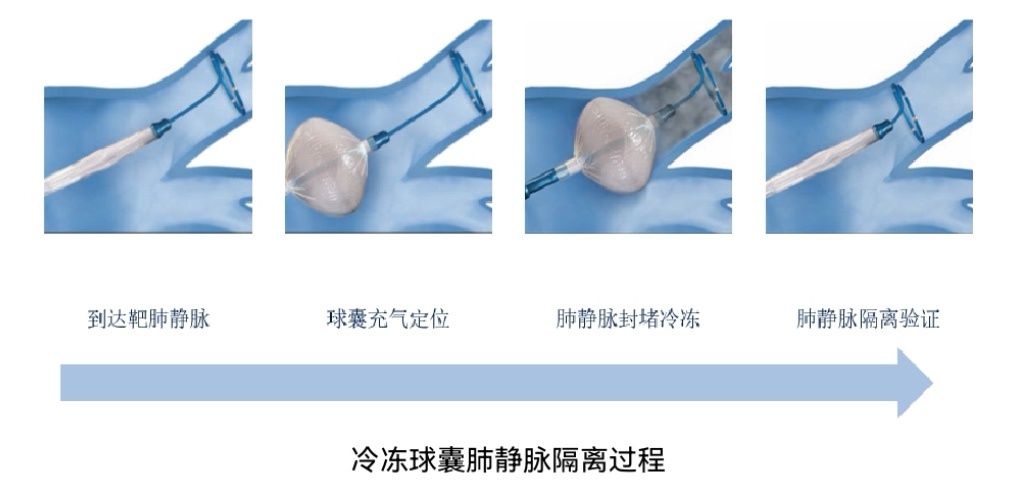 静脉|东莞市中医院成功为80岁患者实施“房颤冷冻消融术”