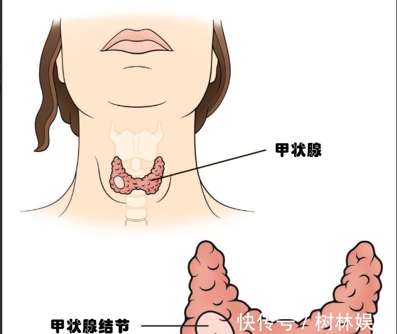 科室|结节、息肉、囊肿、增生哪个最可能癌变这么多年疑惑终于解开了