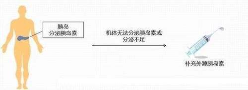  副作用|盘点胰岛素10个副作用，尤其是这4个副作用连医生都不会告诉你