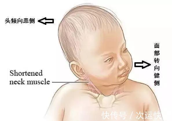 矫正|别把娃抱成了“歪脖子”!这些毁脊椎的抱姿,也许你每天都在做…