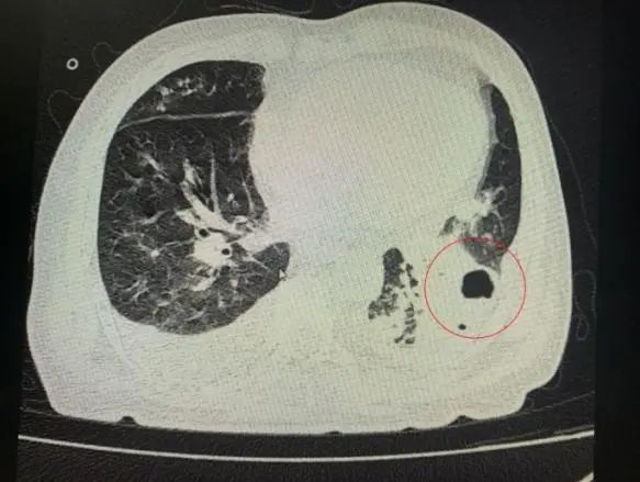 “超低价”种了颗牙，大叔住进ICU！医生提醒：吸入性肺脓肿可致命|惊 | 病原菌