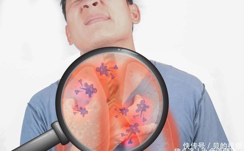 肺癌|它跟肺癌、肝癌关系密切,而你却天天在食用