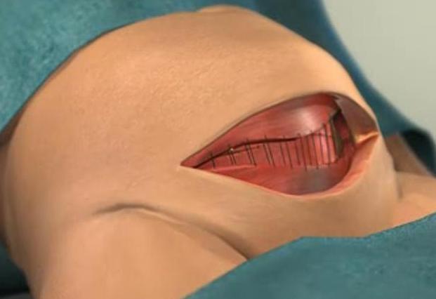 妈妈|剖腹产手术全过程!只有躺在产床上的妈妈,才知道那种滋味