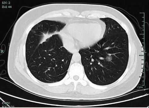 饭店生意越来越红火,“拼命厨娘”却查出了肺癌