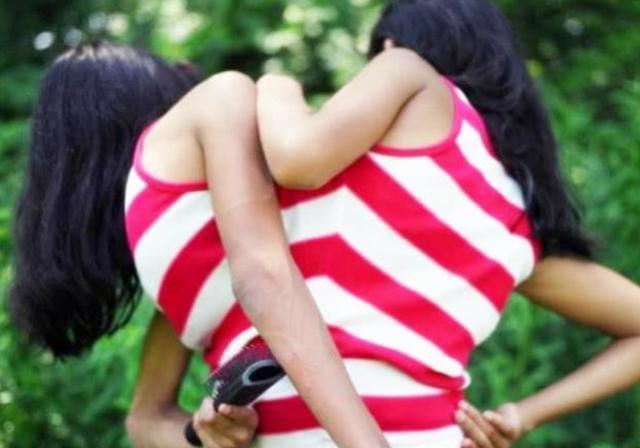 孩子|17年前的连体女婴,医生说“只能活3天”,如今现状超乎众人意料