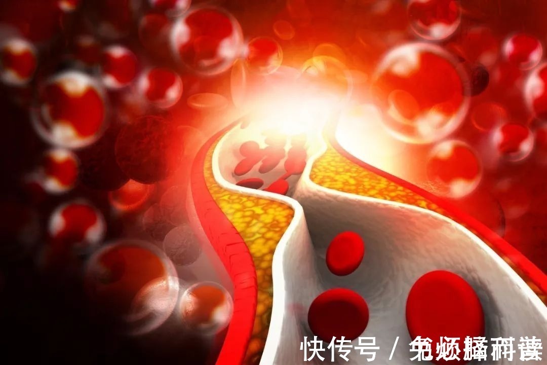 食物|高血脂患者,饮食远离这6种食物,可以有效降血脂,更能延年益寿